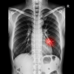 A Gripe Pode Levar a Pneumonia?